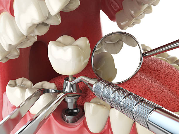 Best Emergency Wisdom Teeth Removal in Saxapahaw, NC